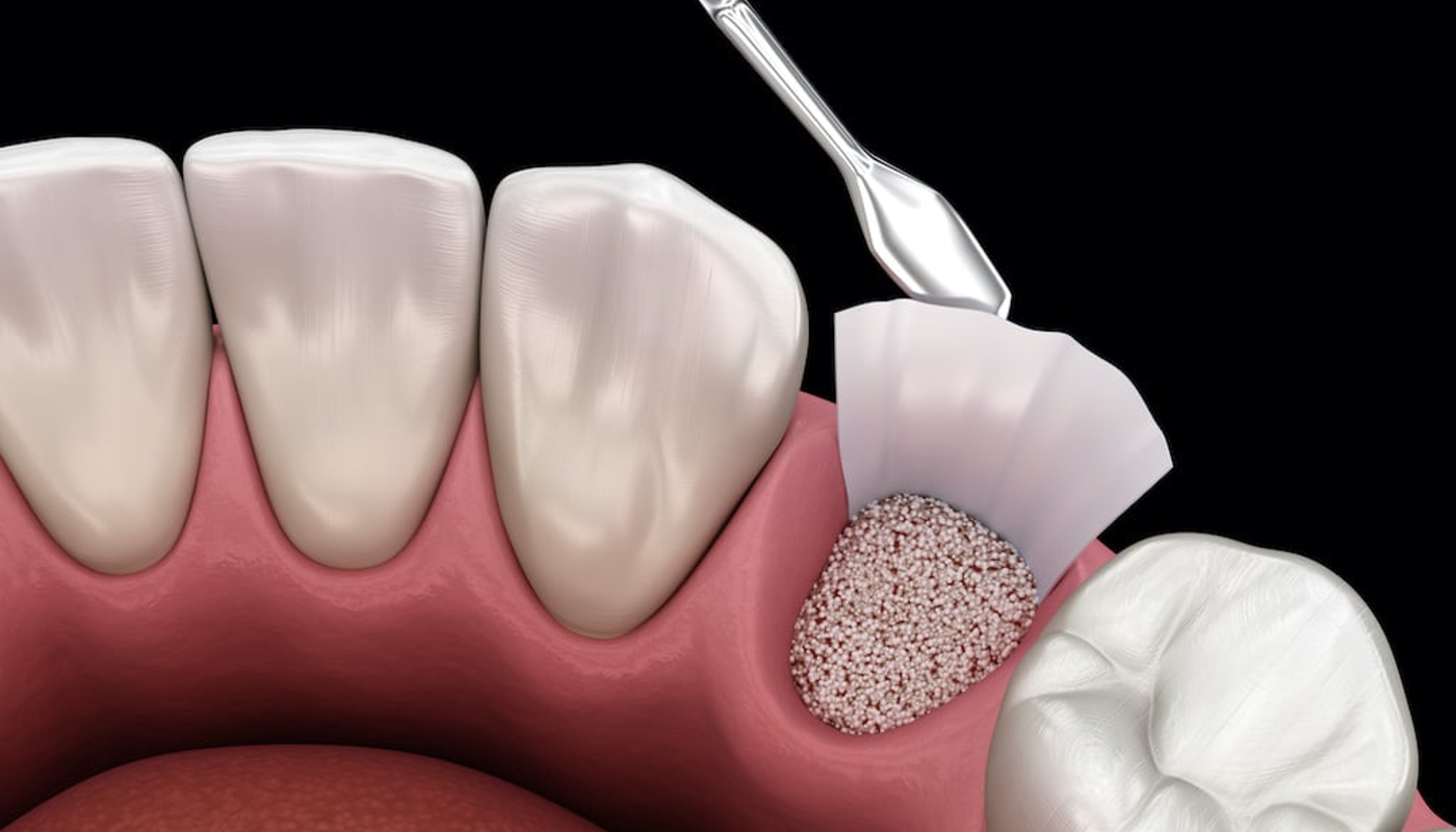 implantologia dentale